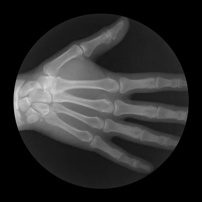 clenching a fist x ray