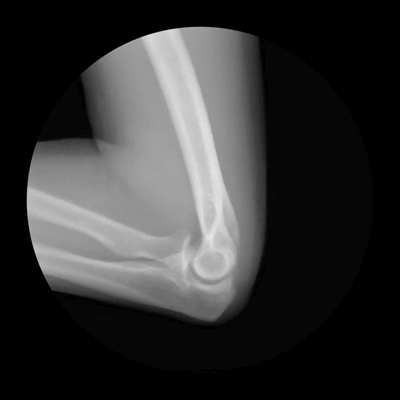 elbow when you bend your arm x ray