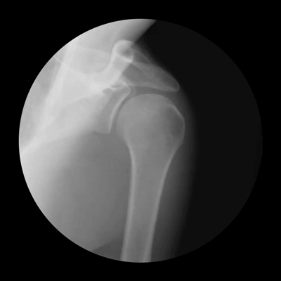 shoulder x ray